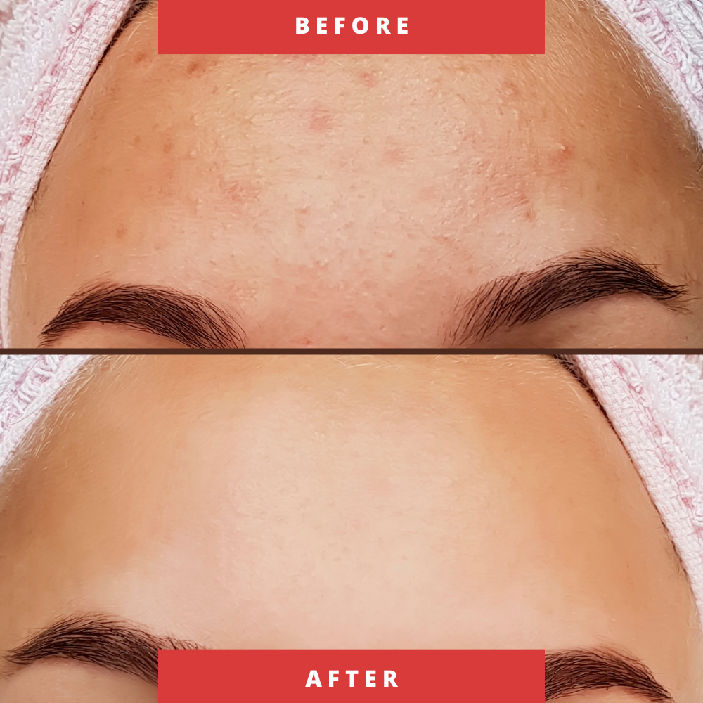 Red Light Therapy Skin Rejuvenation Mask